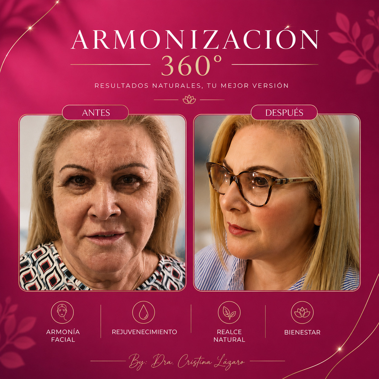 Resultado antes y después de Armonización Facial 360