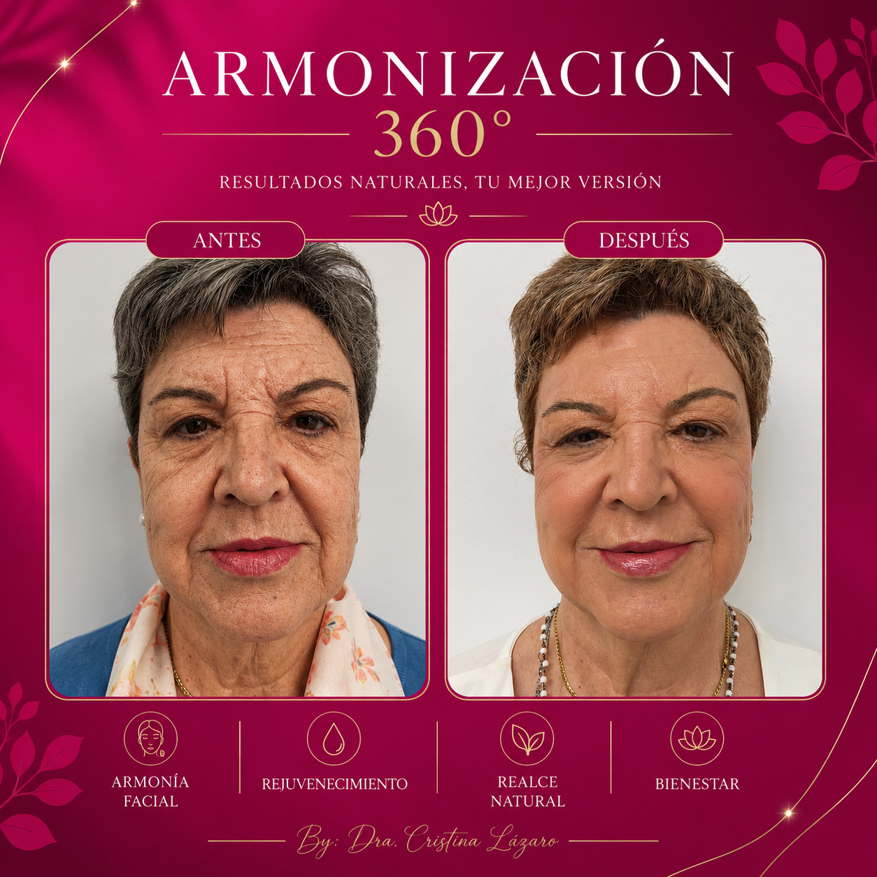Resultado antes y después de Armonización Facial 360